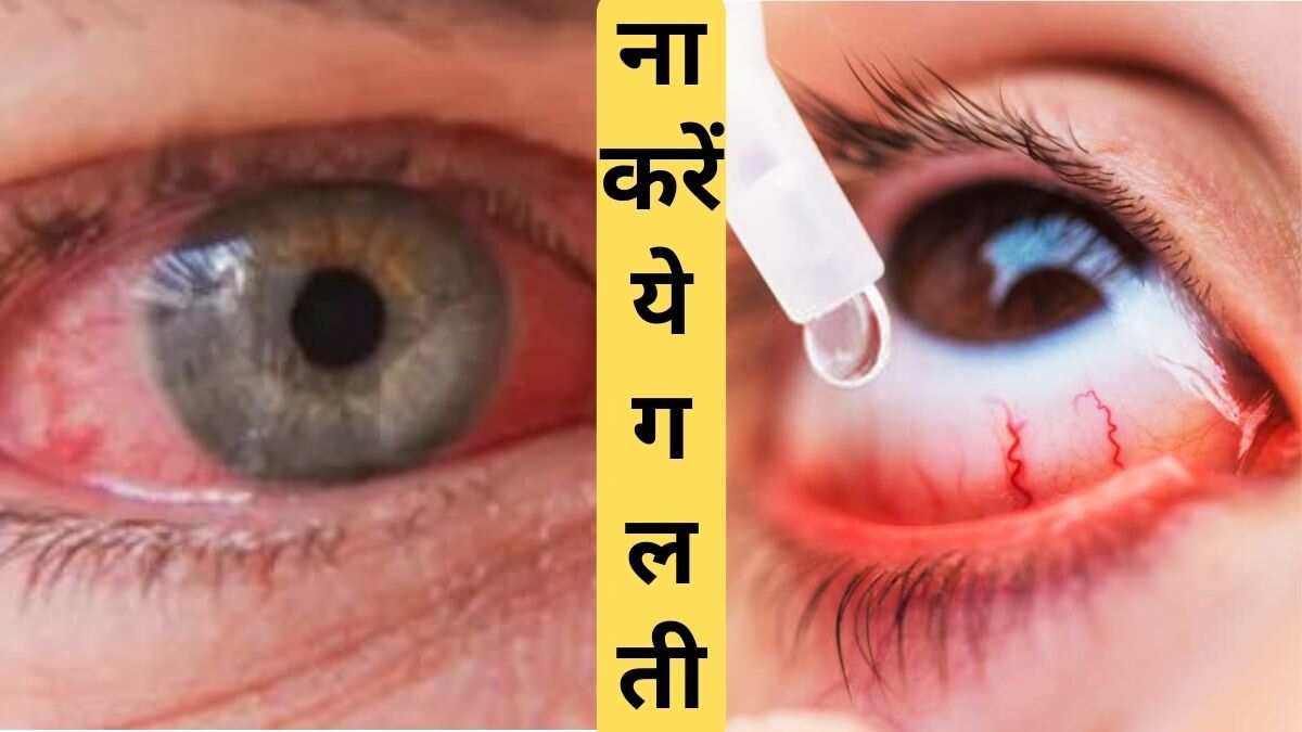 Eye Flu Symptoms